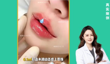 Dr高璇院长丰唇案例