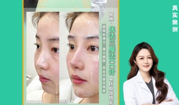 𝐃𝐫 ·高旋院长 优法兰鼻部塑形｜案例