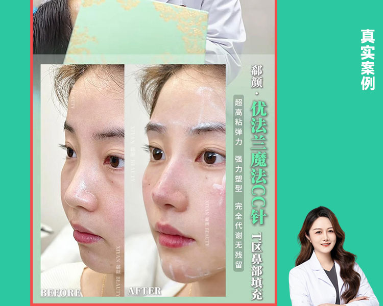 𝐃𝐫 ·高旋院长 优法兰鼻部塑形｜案例